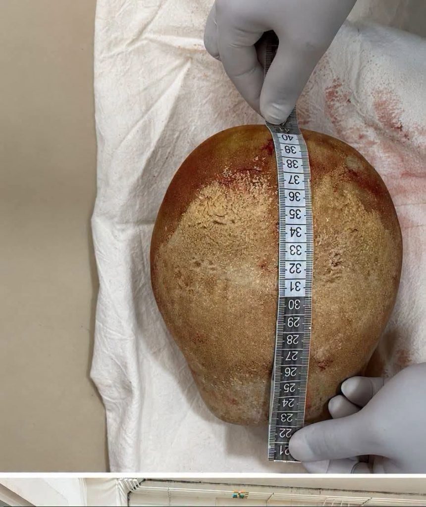 3.1 கிலோ எடையுள்ள சிறுநீரகக் கல்லை சத்திரசிகிச்சை மூலம் அகற்றிய திருகோணமலை பொது வைத்தியசாலை வைத்தியர் குழு