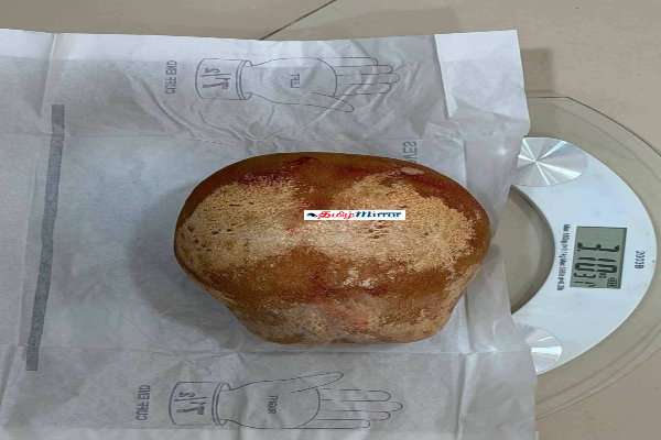 ட்ரிங்கோமালி மருத்துவமனையில் 3.1 கிலோகிராம் எடையுள்ள சிறுநீரக கல் அகற்றப்பட்டது