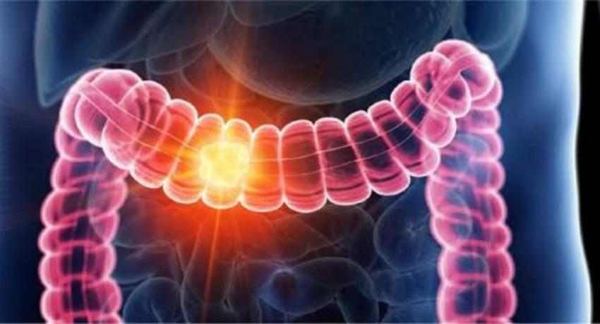 Sri Lankan Doctors Warn of Rising Colorectal Cancer Cases Linked to Lifestyle Changes