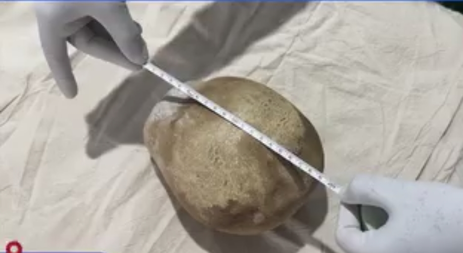 3.1-kg bladder stone removed in Trincomalee surgery, potentially record-breaking